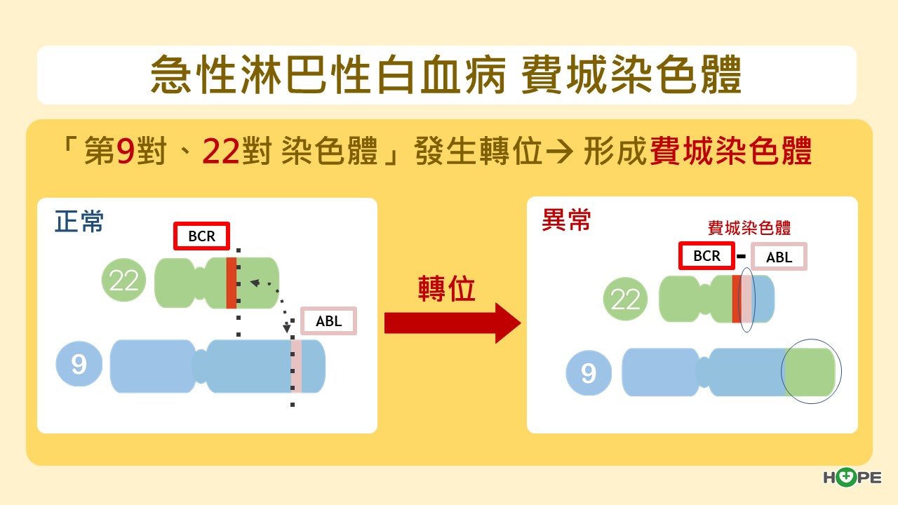急性淋巴性白血病　費城染色體