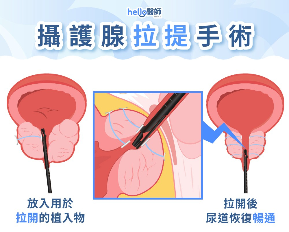 攝護腺拉提手術