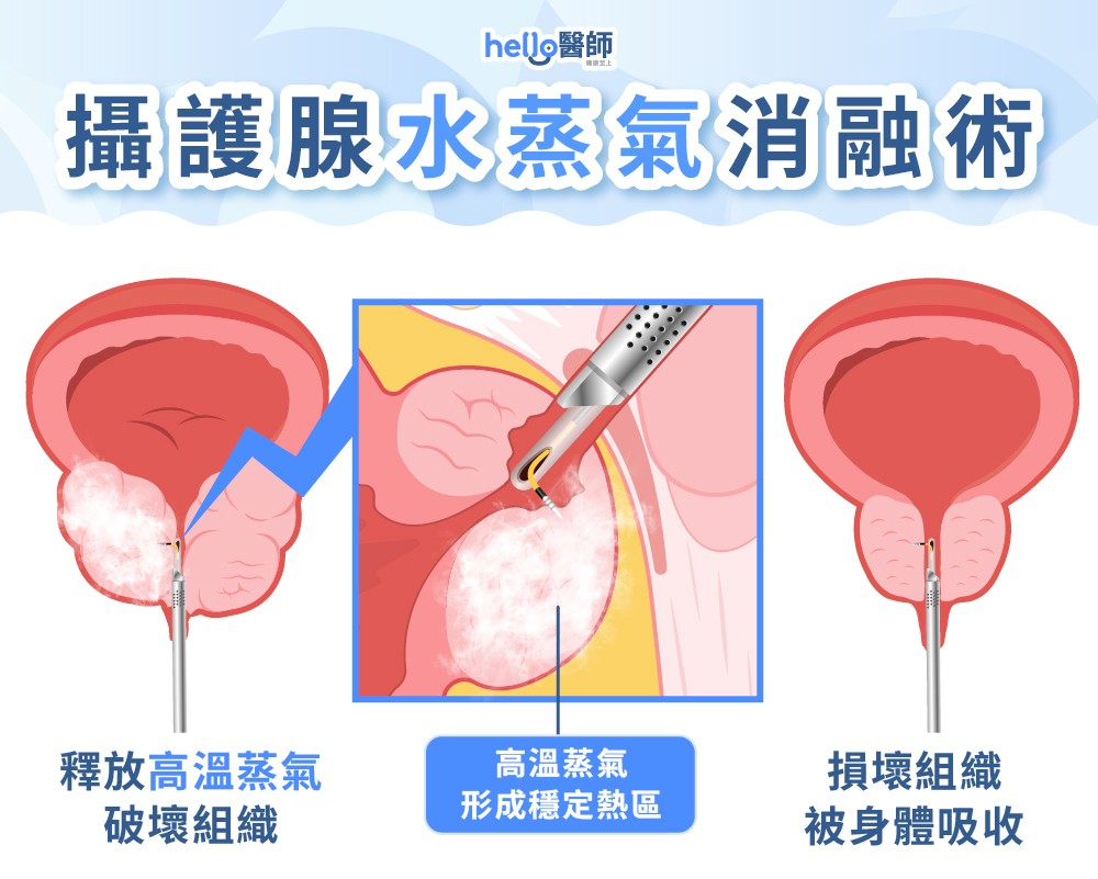 攝護腺水蒸氣消融術