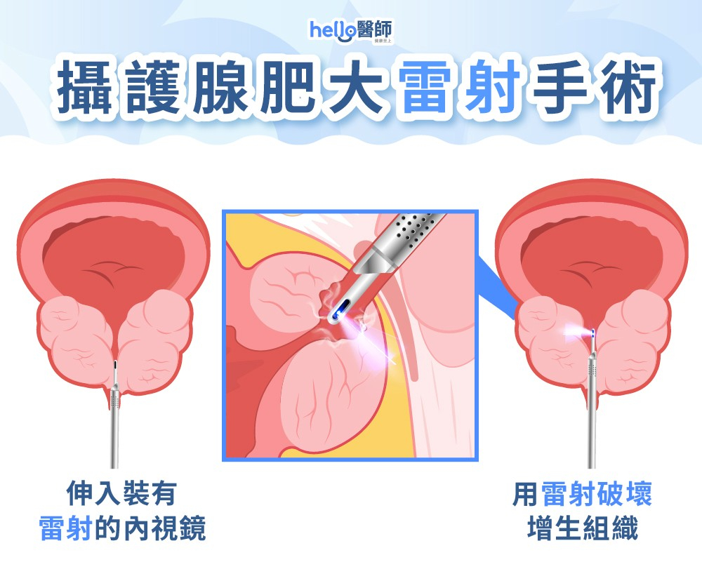 攝護腺肥大雷射手術