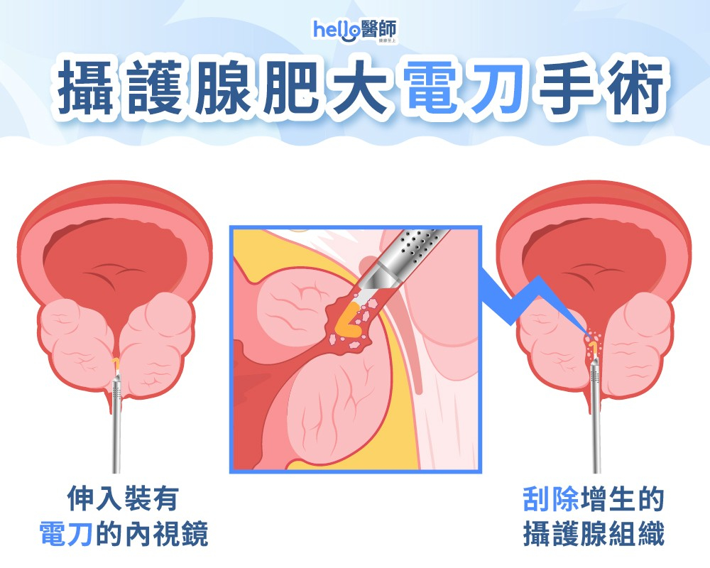 攝護腺肥大電刀手術
