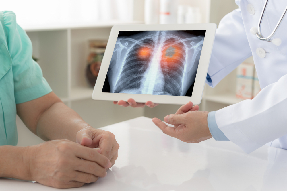 lung-cancer-treatment-alk-key-60-percent