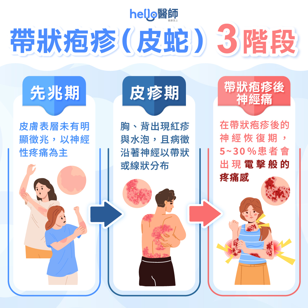 【皮蛇三階段配圖】皮蛇病程分三期,初期以神經性疼痛為主,後期出現帶狀紅疹與水泡,部分患者痊癒後仍可能長期出現疱疹後神經痛。