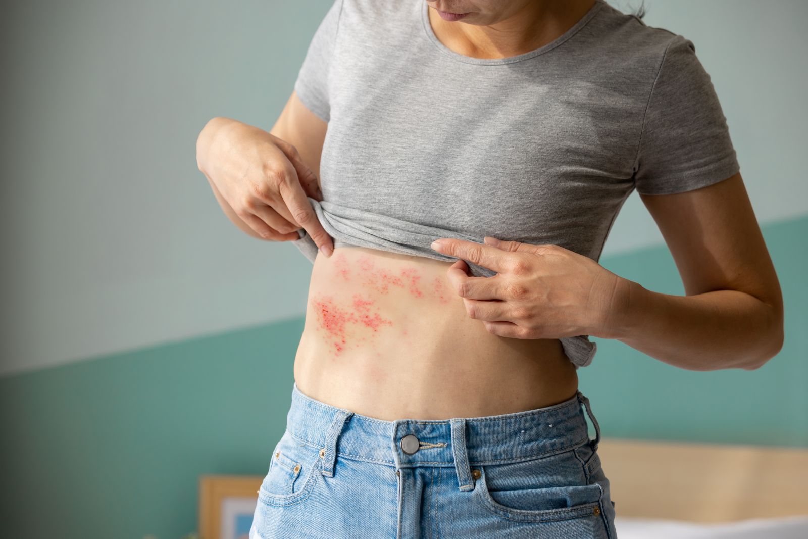 shingles-recovery-time-symptoms-treatment