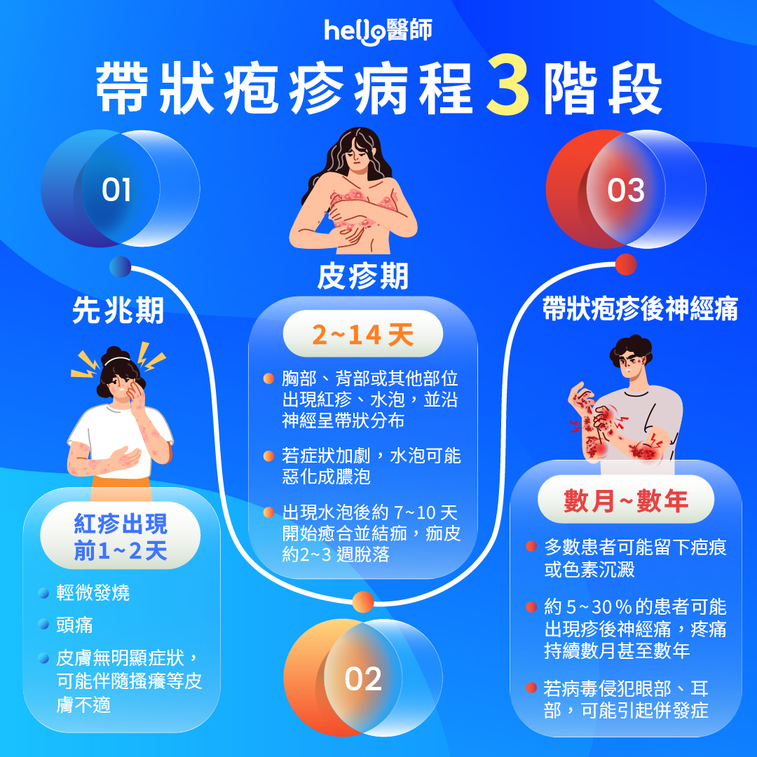 【帶狀疱疹病程三階段配圖】帶狀疱疹病程分為先兆期、皮疹期、疹後期三階段，了解各階段症狀才能盡早治療。