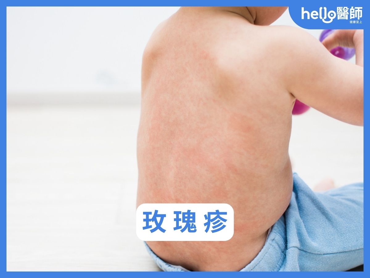 寶寶玫瑰疹